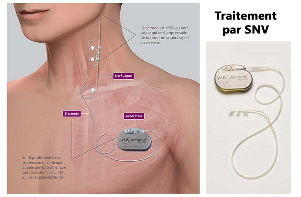 Schéma représentant le traitement de l'épilepsie par stimulation du nerf vague