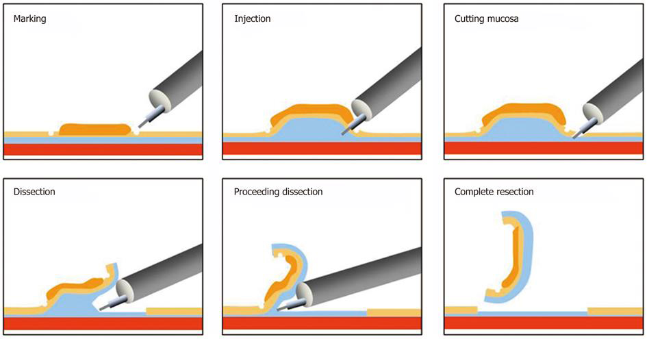 image d'illustration de la technique de dissection sous muqueuse extraite de : Asano M. World J Gastrointest Endosc 2012; 4(10): 438-447