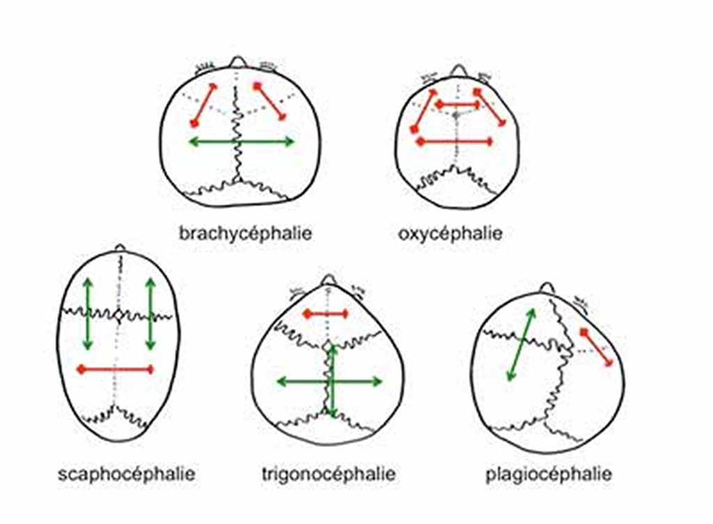 Les différents types de craniosténoses, selon le type de suture impliqué 