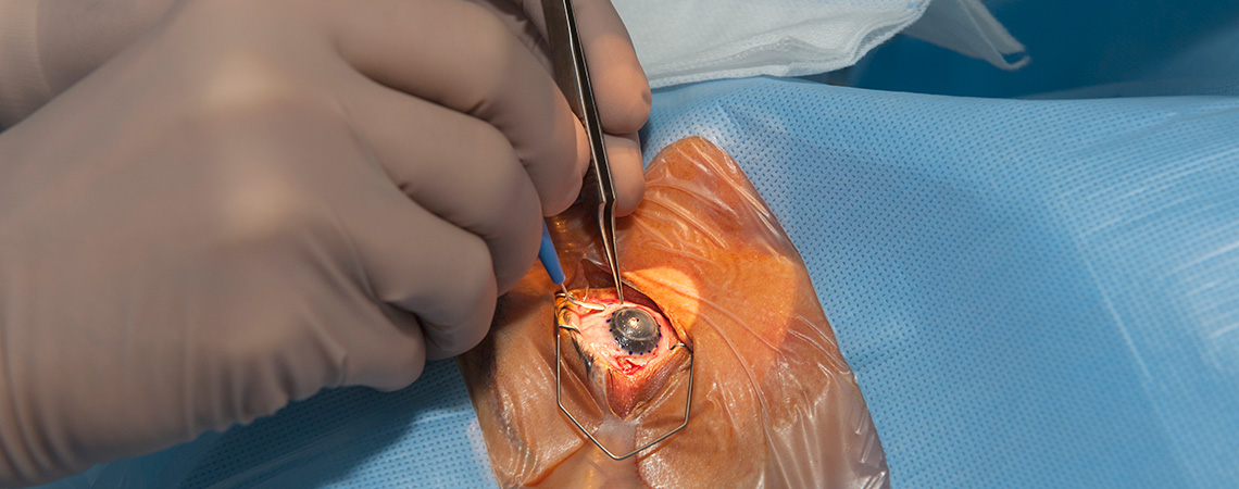 Greffe de cornée au bloc chirurgical