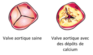 Rétrécissement aortique
