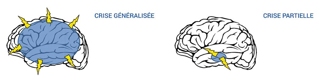 Schémas de cerveaux représentant les deux types de crises d'épilepsie ; cette dernière est une pathologie prise en charge en neurophysiologie.
