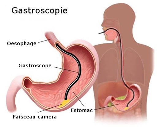 Gastroscopie