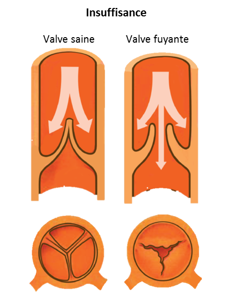 Schéma illustrant une insuffisance des valves aortiques