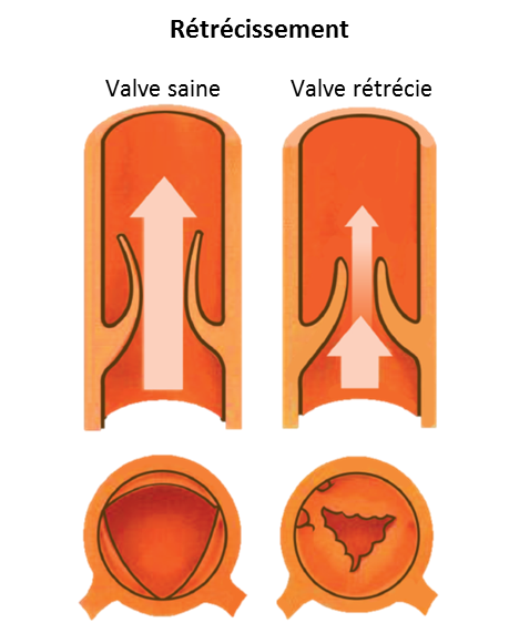 Schéma illustrant un rétrécissement des valves aortiques