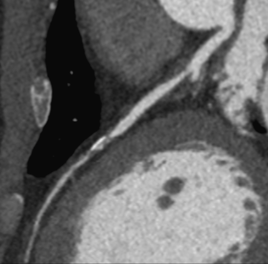 Scanner stenose coronaire